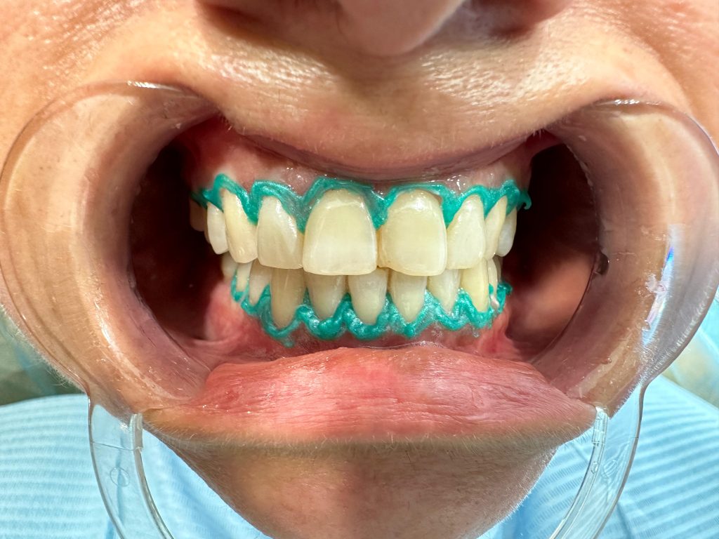 Rezultati pas kryerjes së shërbimit te zbardhimit te dhëmbëve